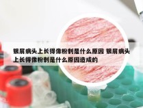 银屑病头上长得像粉刺是什么原因 银屑病头上长得像粉刺是什么原因造成的