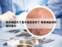 银屑病连片了是不是就快好了 银屑病连成片是好是坏