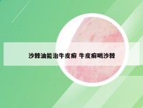沙棘油能治牛皮癣 牛皮癣喝沙棘