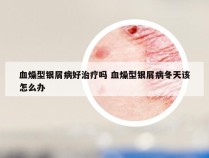 血燥型银屑病好治疗吗 血燥型银屑病冬天该怎么办