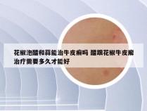 花椒泡醋和蒜能治牛皮癣吗 醋跟花椒牛皮廨治疗需要多久才能好