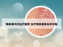银屑病中药治疗医院 治疗银屑病有名的中医