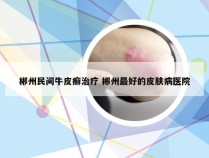 郴州民间牛皮癣治疗 郴州最好的皮肤病医院