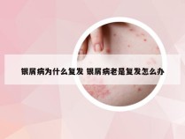 银屑病为什么复发 银屑病老是复发怎么办