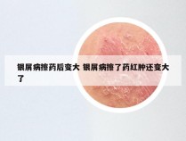 银屑病擦药后变大 银屑病擦了药红肿还变大了