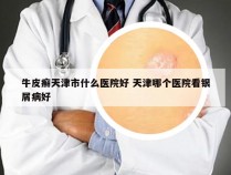 牛皮癣天津市什么医院好 天津哪个医院看银屑病好