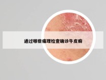 通过哪些痛理检查确诊牛皮癣