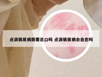点滴银屑病需要忌口吗 点滴银屑病会自愈吗