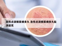 急性点滴银屑病多久 急性点滴银屑病多久能消退完