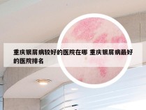 重庆银屑病较好的医院在哪 重庆银屑病最好的医院排名