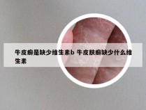 牛皮癣是缺少维生素b 牛皮肤癣缺少什么维生素
