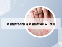 银屑病会不会蔓延 银屑病会伴随人一生吗