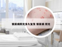 银屑病照光多久复发 银屑病 照光