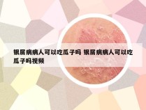 银屑病病人可以吃瓜子吗 银屑病病人可以吃瓜子吗视频