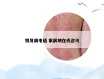 银屑病电话 银屑病在线咨询