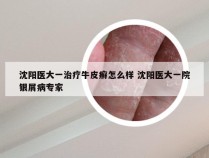 沈阳医大一治疗牛皮癣怎么样 沈阳医大一院银屑病专家
