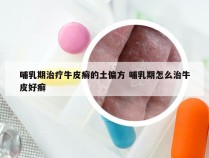 哺乳期治疗牛皮癣的土偏方 哺乳期怎么治牛皮好癣
