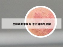 怎样诊断牛皮癣 怎么确诊牛皮廨
