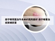 南宁哪家医治牛皮癣的医院最好 南宁哪里治皮肤病厉害