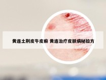 黄连土荆皮牛皮癣 黄连治疗皮肤病秘验方