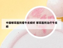 中国哪家医院看牛皮癣好 那家医院治疗牛皮癣