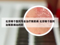 北京哪个医院专业治疗银屑病 北京哪个医院治银屑病治的好