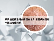 银屑病能根治吗去择西安北方 银屑病陕西哪个医院治疗的好