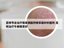 昆明专业治疗银屑病医院哪家最好的医院 昆明治疗牛癣哪家好