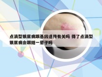 点滴型银屑病跟基因遗传有关吗 得了点滴型银屑病会跟随一辈子吗