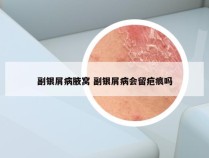 副银屑病腋窝 副银屑病会留疤痕吗