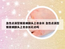 急性点滴型银屑病额头上也会长 急性点滴型银屑病额头上也会长红点吗