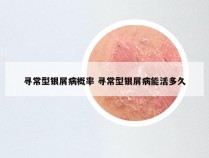 寻常型银屑病概率 寻常型银屑病能活多久
