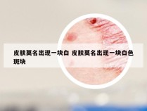 皮肤莫名出现一块白 皮肤莫名出现一块白色斑块
