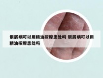 银屑病可以用精油按摩患处吗 银屑病可以用精油按摩患处吗