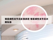 银屑病性关节炎影像表现 银屑病性关节炎诊断标准