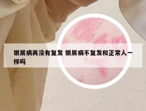 银屑病再没有复发 银屑病不复发和正常人一样吗