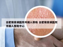 合肥银屑病医院寻国人帮助 合肥银屑病医院寻国人帮助中心