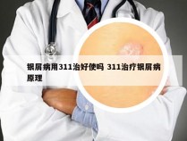 银屑病用311治好使吗 311治疗银屑病原理