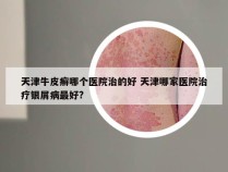 天津牛皮癣哪个医院治的好 天津哪家医院治疗银屑病最好?