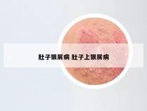 肚子银屑病 肚子上银屑病