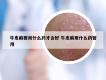 牛皮癣要用什么药才会好 牛皮癣用什么药管用