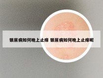 银屑病如何晚上止痒 银屑病如何晚上止痒呢