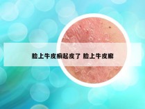 脸上牛皮癣起皮了 脸上牛皮廨