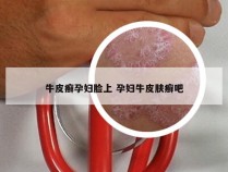 牛皮癣孕妇脸上 孕妇牛皮肤癣吧