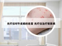光疗仪对牛皮癣的危害 光疗仪治疗银屑病