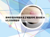 郑州华夏白斑医院是正规医院吗 激光做308几次白斑能好