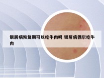 银屑病恢复期可以吃牛肉吗 银屑病偶尔吃牛肉