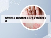 血热型银屑病可以喝姜汤吗 银屑病能喝姜汤吗