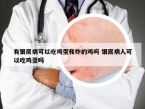 有银屑病可以吃鸡蛋和炸的鸡吗 银屑病人可以吃鸡蛋吗