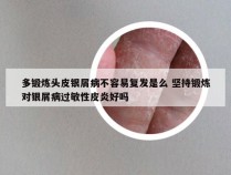 多锻炼头皮银屑病不容易复发是么 坚持锻炼对银屑病过敏性皮炎好吗